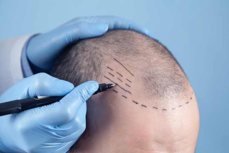 Hair Transplant treatments at Pearl Aesthetic, Koramangala, Bengaluru